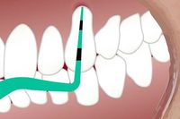 изправяне на зъби - 69267 комбинации