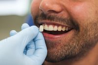 зъбни импланти - 58373 селекции