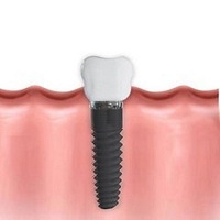 поставяне на зъбни импланти - 31304 цени
