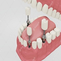 поставяне на зъбни импланти - 44021 разновидности