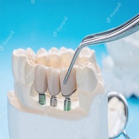 поставяне на зъбни импланти - 98767 комбинации