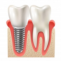 поставяне на зъбни импланти - 69363 възможности