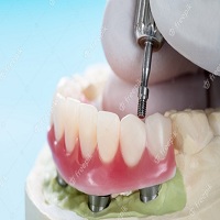 поставяне на зъбни импланти - 2594 комбинации