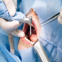 поставяне на зъбни импланти - 87770 бестселъри