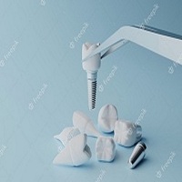 поставяне на зъбни импланти - 44346 селекции