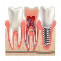 възстановяване след поставяне на зъбни импланти - 90764 клиенти