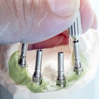 възстановяване след поставяне на зъбни импланти - 87605 предложения