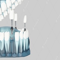 възстановяване след поставяне на зъбни импланти - 6251 клиенти