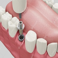 възстановяване след поставяне на зъбни импланти - 38515 типа
