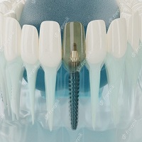 възстановяване след поставяне на зъбни импланти - 33242 възможности