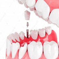 видове зъбни импланти - 60209 разновидности