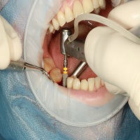зъбни импланти цена - 25514 селекции