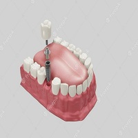 зъбни импланти цена - 41230 награди