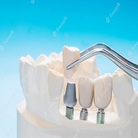 зъбни импланти цена - 97473 разновидности