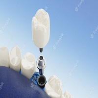 зъбни импланти цена - 21135 цени