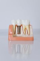 зъбни импланти - 89112 селекции